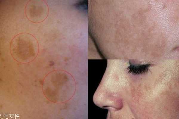 孕斑长什么样子,孕斑是什么样子的