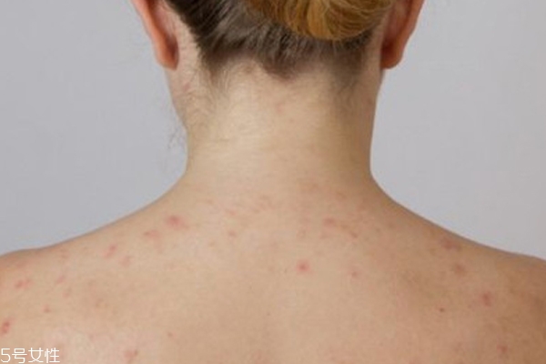 痘痘的位置代表身体哪里出现问题,痘痘的位置和健康