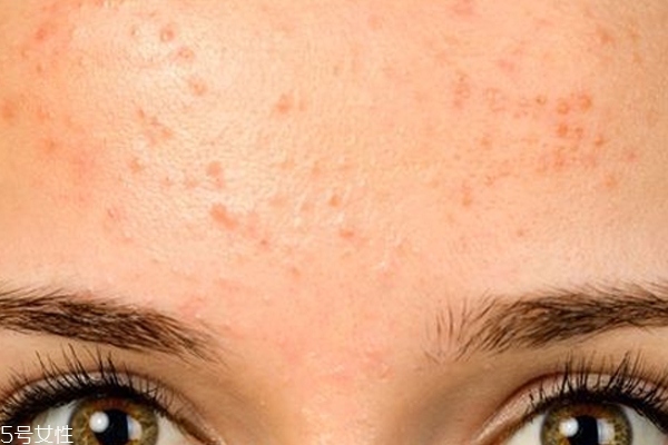额头冒大痘痘什么原因,额头突然冒很多痘是为什么