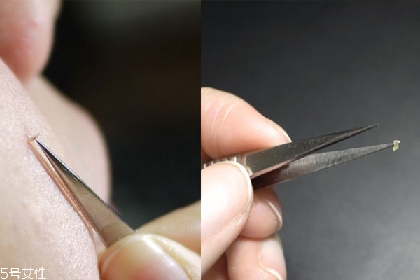 挤痘痘用什么工具最好,用挤痘痘的工具挤了会怎么样 挤痘痘用什么工具最好,用挤痘痘的工具挤了会怎么样