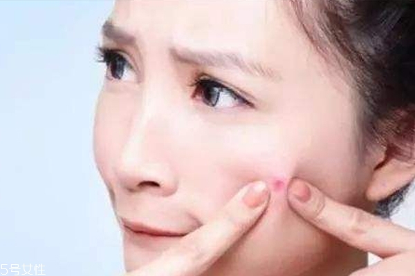 什么痘痘不能挤,哪三个地方的痘痘不能挤