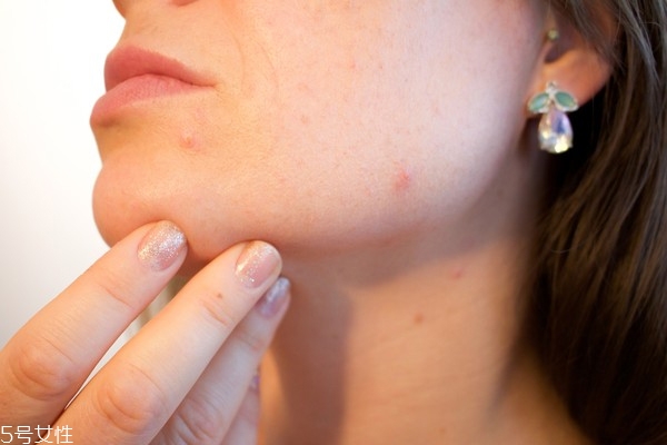 疯狂长痘怎么办,怎么治痘痘 疯狂长痘怎么办,怎么治痘痘