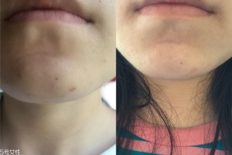 百肤美除疤效果怎么样,美百颜祛皱效果咋样