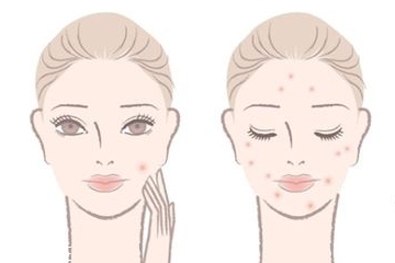 祛痘精华液的作用,精华液祛痘吗