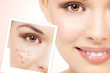 去痘痘用什么精油好,长痘痘用什么精油