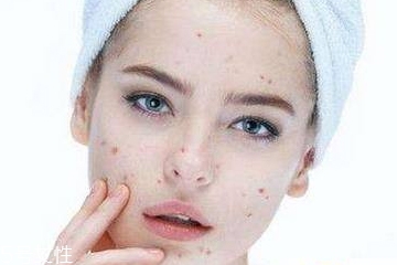 粉刺痘痘可以挤掉吗,痘能不能挤掉