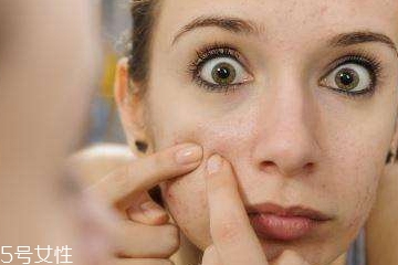 顽固痘痘怎么才能根治,顽固性痤疮怎样治疗 顽固痘痘怎么才能根治,顽固性痤疮怎样治疗