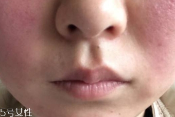 视黄醇致痘,视黄醇可以祛痘吗