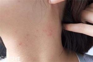 脖子上长痘痘怎么消除,脸上脖子上长痘痘怎么办 脖子上长痘痘怎么消除,脸上脖子上长痘痘怎么办