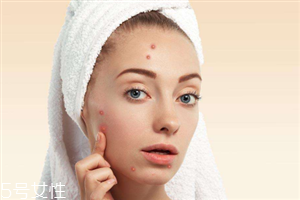 脸上为什么长痘,脸上经常长痘痘是怎么回事 脸上为什么长痘,脸上经常长痘痘是怎么回事