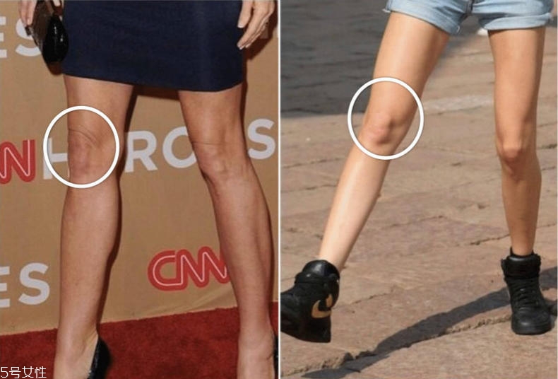 皱纹有哪些种类,皱纹分几种类型