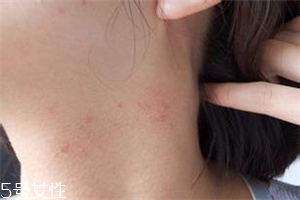 脖子上长痘痘什么原因怎么治疗,脖子长了很多痘痘怎么回事