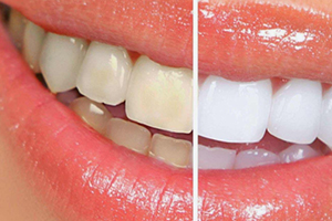 牙贴和美牙仪哪个好,牙贴和美牙仪哪个好用
