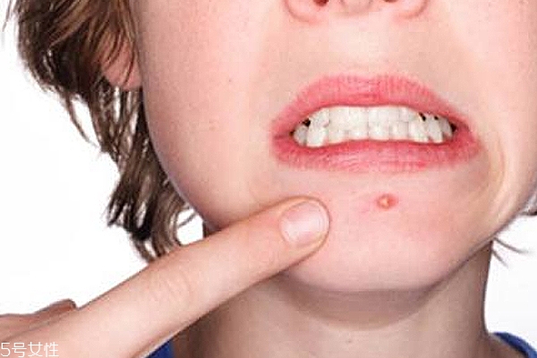 脸上出油是有螨虫吗?,螨虫导致出油 脸上出油是有螨虫吗?,螨虫导致出油