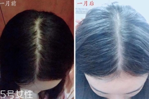 柳屋生发水开了一年还能用吗,柳屋生发液多久见效 柳屋生发水开了一年还能用吗,柳屋生发液多久见效