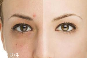 祛痘产品怎么选,有效的祛痘产品首选 祛痘产品怎么选,有效的祛痘产品首选