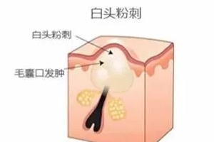 闭口反反复复长到底怎样才能根治,闭口如何消除