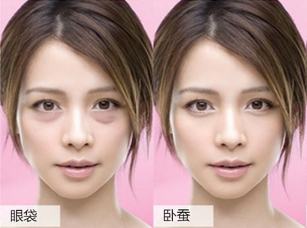 卧蚕和眼袋的区别图片,眼袋卧蚕怎么区分图片