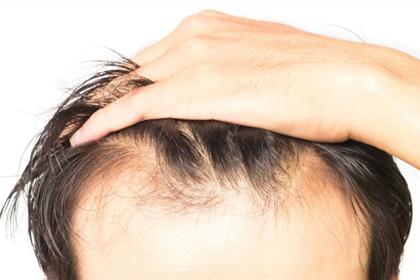 植发是什么意思?,什么是毛发移植