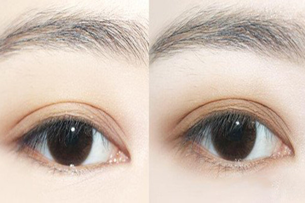 吸雕双眼皮的原理,吸雕双眼皮是什么