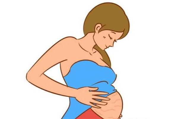 激光祛妊娠纹一般要做几次,激光能去妊娠纹吗 激光祛妊娠纹一般要做几次,激光能去妊娠纹吗