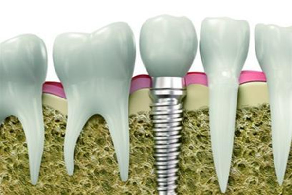 种植牙二期多久拆线,种牙几天后可以拆线