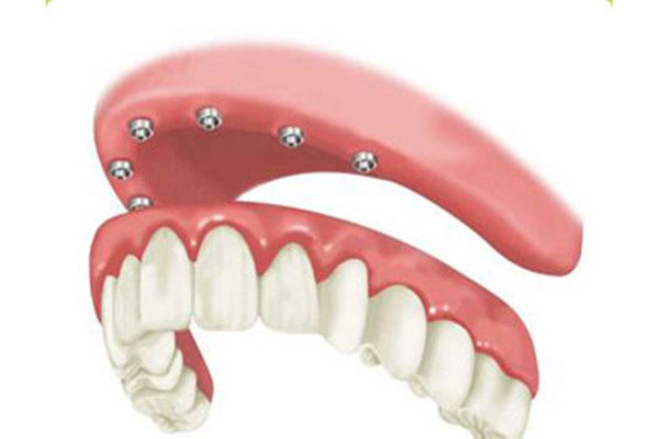 种植牙旁边的牙龈红肿,种植牙的牙龈红肿疼痛是什么原因