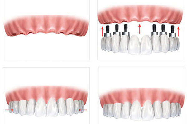 种了种植牙要注意什么,种植牙齿需要注意什么