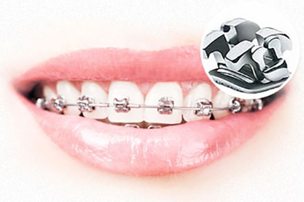 牙缝大能做矫正吗需要多久,牙缝大可以矫正吗