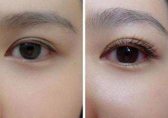 种睫毛需要打麻药吗,种植睫毛疼吗