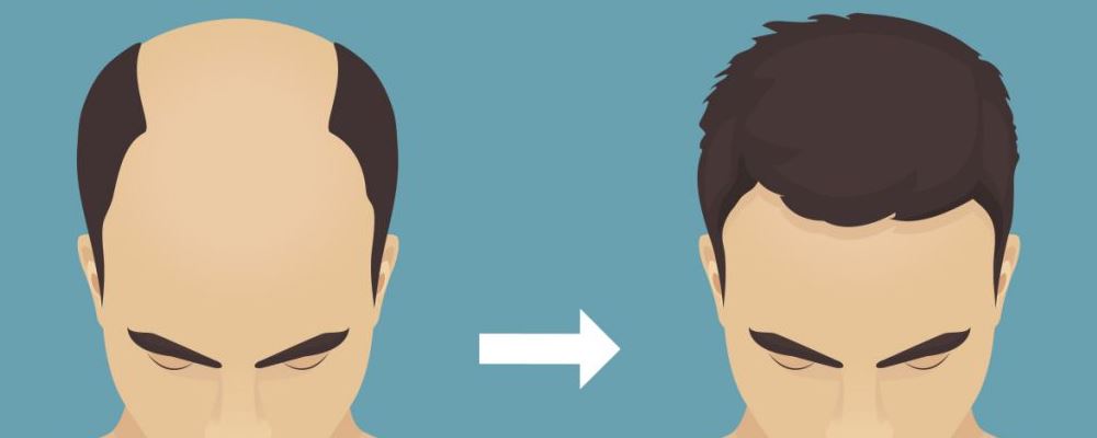 自体毛发移植,毛发移植是什么原理