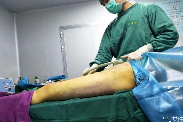 大腿抽脂后有硬块正常吗,大腿抽脂半个月了里面有硬块怎么办