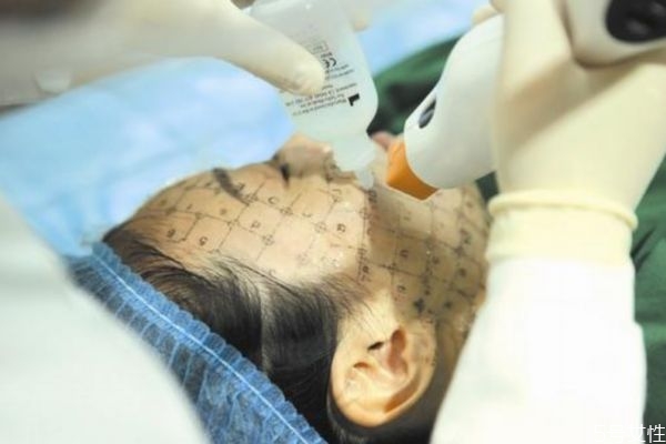 做热玛吉多久有效果,小热玛吉做一次的效果是多久 做热玛吉多久有效果,小热玛吉做一次的效果是多久