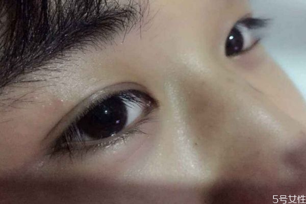 割双眼皮会有什么危害,割双眼皮有哪些危害性