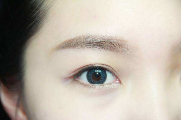 重睑修复术是什么意思,重睑手术方法