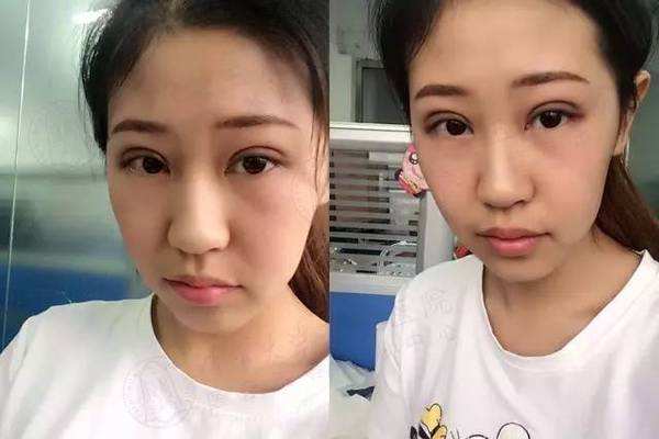 5s重睑术能维持多久,5s重睑术是怎么做的 5s重睑术能维持多久,5s重睑术是怎么做的