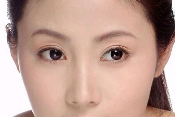 重睑术是割双眼皮吗,双眼皮手术要害 重睑术是割双眼皮吗,双眼皮手术要害
