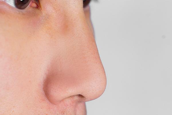 垫鼻根用什么方法最好,垫鼻子可以只垫鼻山根 垫鼻根用什么方法最好,垫鼻子可以只垫鼻山根