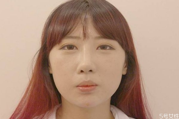 垫下巴绷带多久可以拆下来?,垫下巴手术伤口一般多久愈合 垫下巴绷带多久可以拆下来?,垫下巴手术伤口一般多久愈合