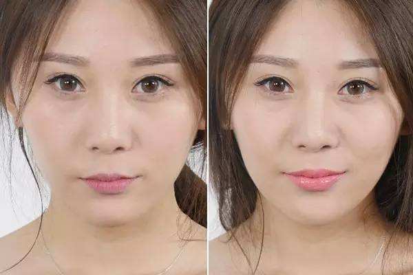 丰唇和嘟嘟唇的区别,什么叫嘟嘟唇