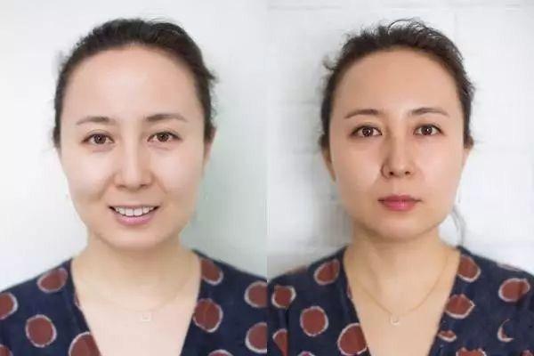 丰苹果肌有几种方法,丰苹果肌什么方法最好 丰苹果肌有几种方法,丰苹果肌什么方法最好