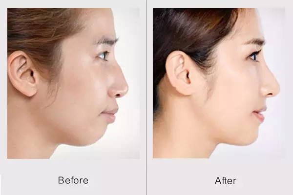 自体脂肪丰下巴还是假体好,自体脂肪下巴效果好吗