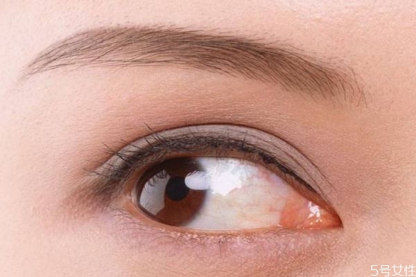 开眼角一般多久可以恢复,开眼角恢复期多久