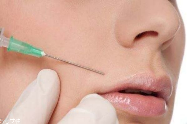 法令纹填充前后照片,法令纹前后对比照片