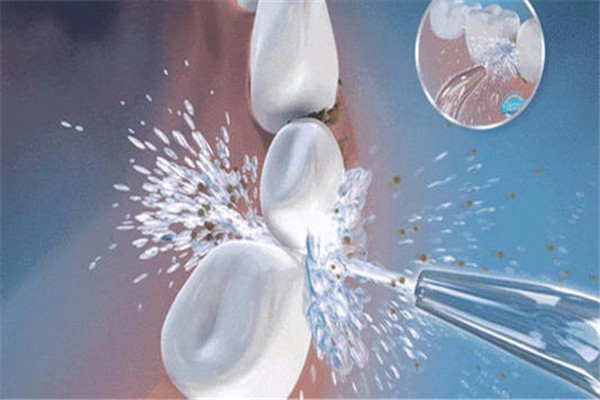 洗牙会不会伤害牙釉质,洗牙会影响牙齿表面的牙釉质吗 洗牙会不会伤害牙釉质,洗牙会影响牙齿表面的牙釉质吗