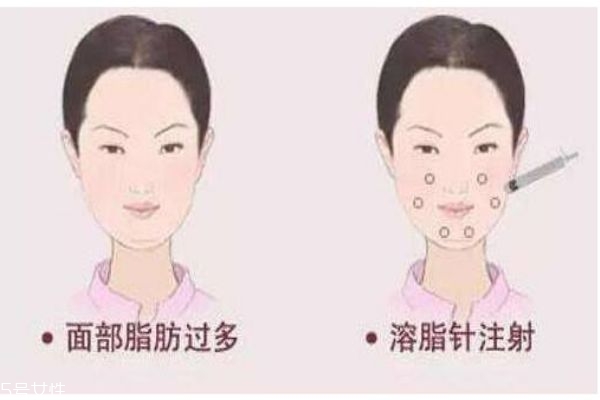 溶脂针作用原理,溶脂针的主要成分及原理