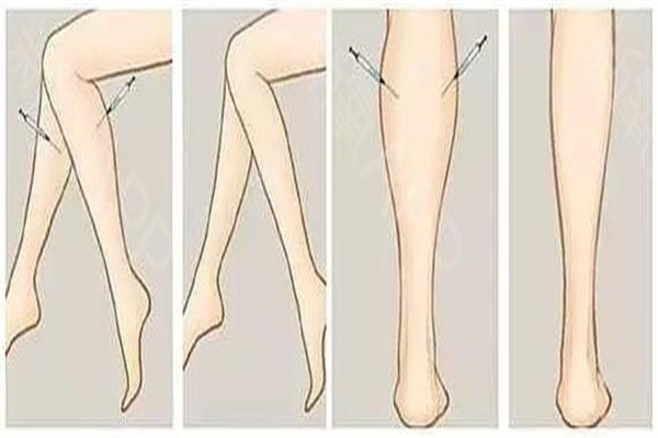 瘦腿针要打几次才能永久,瘦腿针多长时间打一次还是可以永久