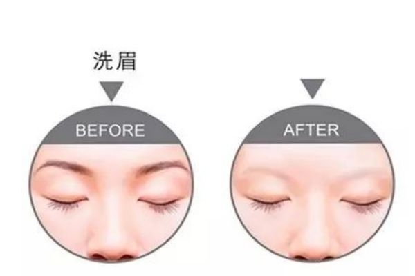 洗眉一般用什么激光,洗眉除了激光还有什么办法