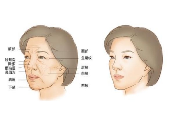 自体脂肪填充什么意思,除了自体脂肪填充还有什么填充