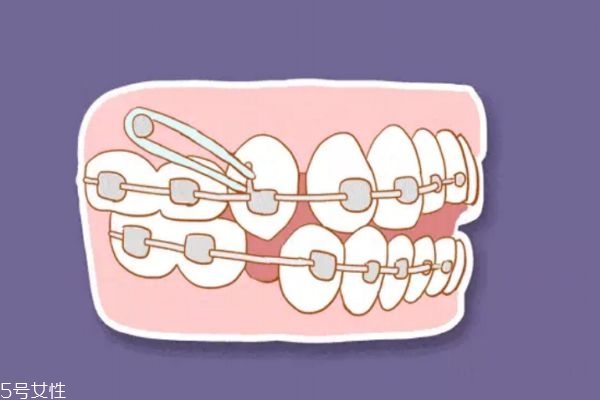 支抗钉有什么用,支抗钉的作用